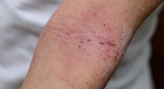 Dry/cracked skin associated with eczema