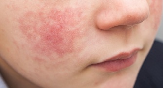 Redness associated with eczema