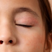 Eczema person eyelid