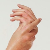 Eczema person hands