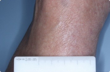 Ankle of clinical trial patient 1 week after ZORYVE treatment