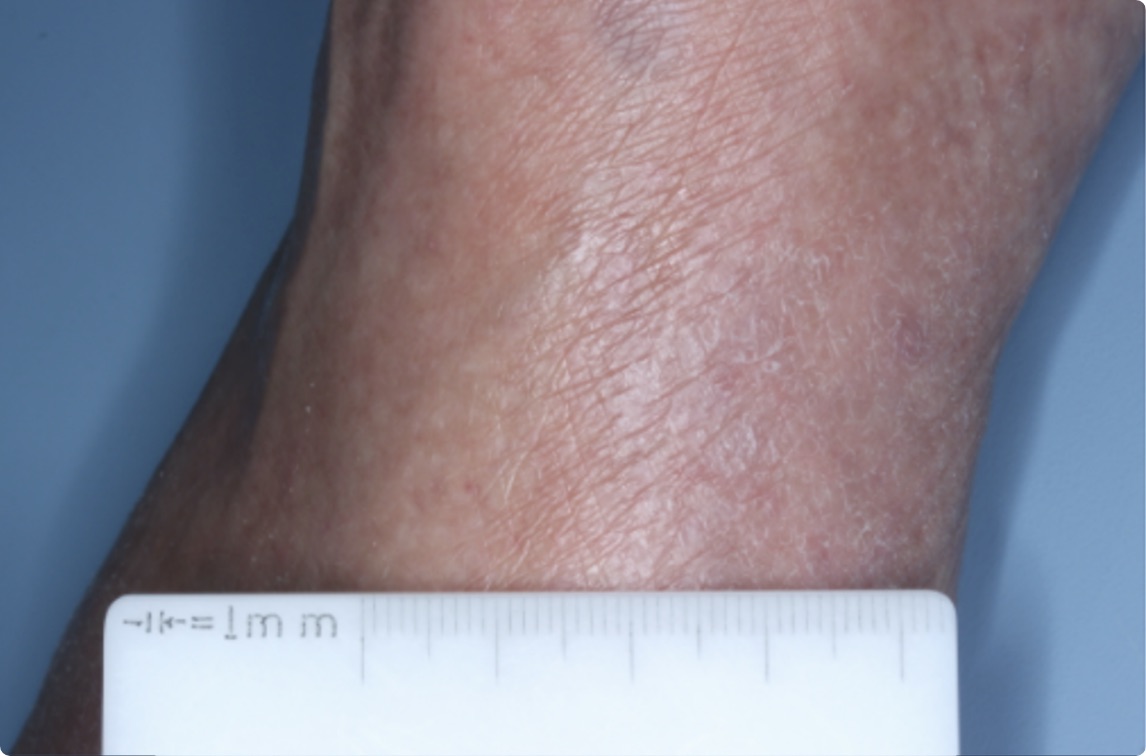 Ankle of clinical trial patient 1 week after ZORYVE treatment