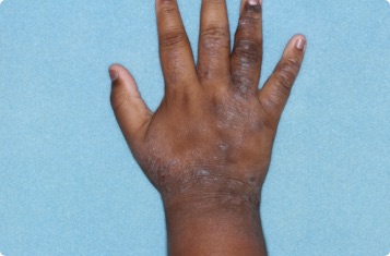 Hand of clinical trial patient before starting treatment with ZORYVE