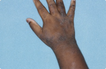 Hand of clinical trial patient 1 week after ZORYVE treatment