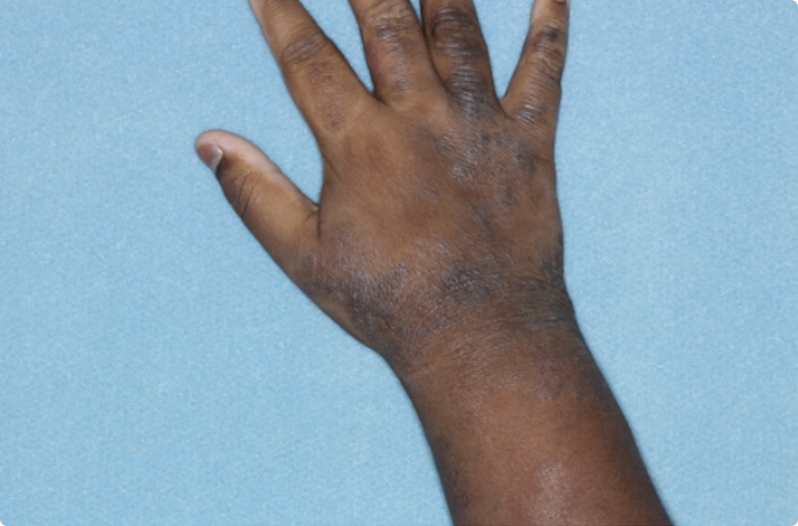 Hand of clinical trial patient 1 week after ZORYVE treatment