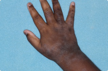 Hand of clinical trial patient 4 weeks after ZORYVE treatment