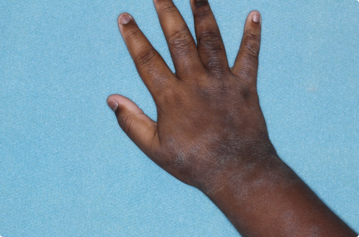 Hand of clinical trial patient 4 weeks after ZORYVE treatment