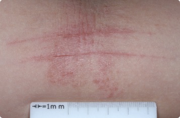 Inside elbow of clinical trial patient before starting treatment with ZORYVE