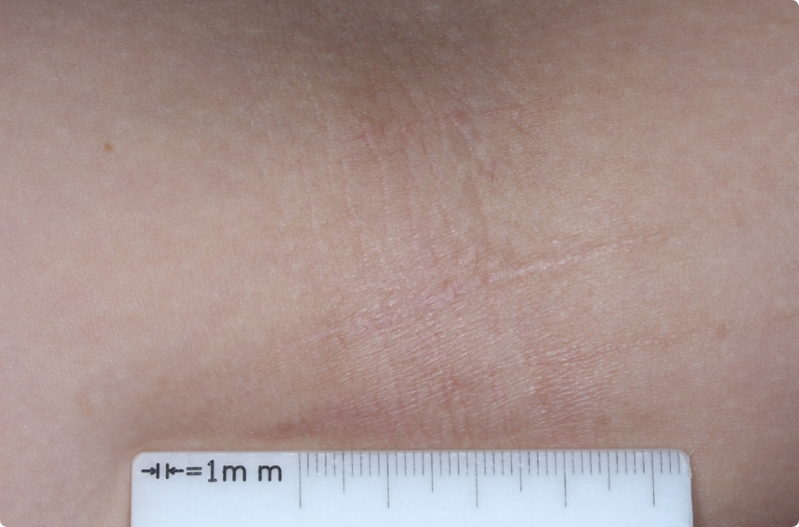 Inside elbow of clinical trial patient 1 week after ZORYVE treatment