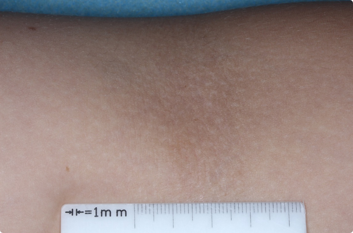 Inside elbow of clinical trial patient 4 weeks after ZORYVE treatment