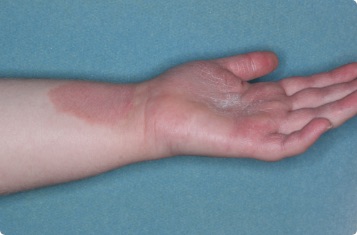 Hand & inside wrist of clinical trial patient before starting treatment with ZORYVE