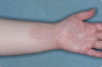 Hand & inside wrist of clinical trial patient 1 week after ZORYVE treatment