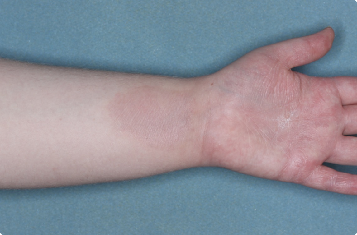 Hand & inside wrist of clinical trial patient 1 week after ZORYVE treatment