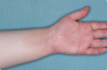 Hand & inside wrist of clinical trial patient 4 weeks after ZORYVE treatment