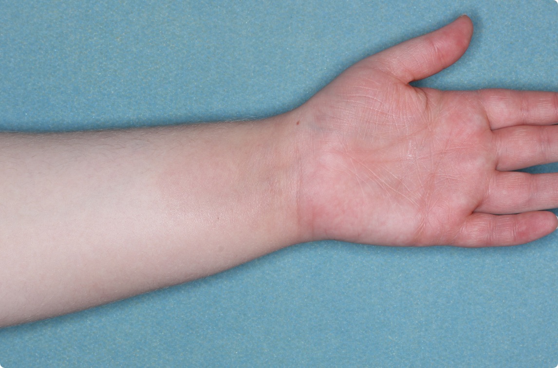 Hand & inside wrist of clinical trial patient 4 weeks after ZORYVE treatment