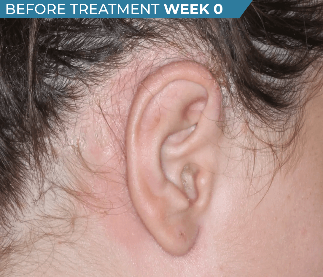 Caucasian American ear with seborrheic dermatitis before treatment (actual clinical trial patient photo)