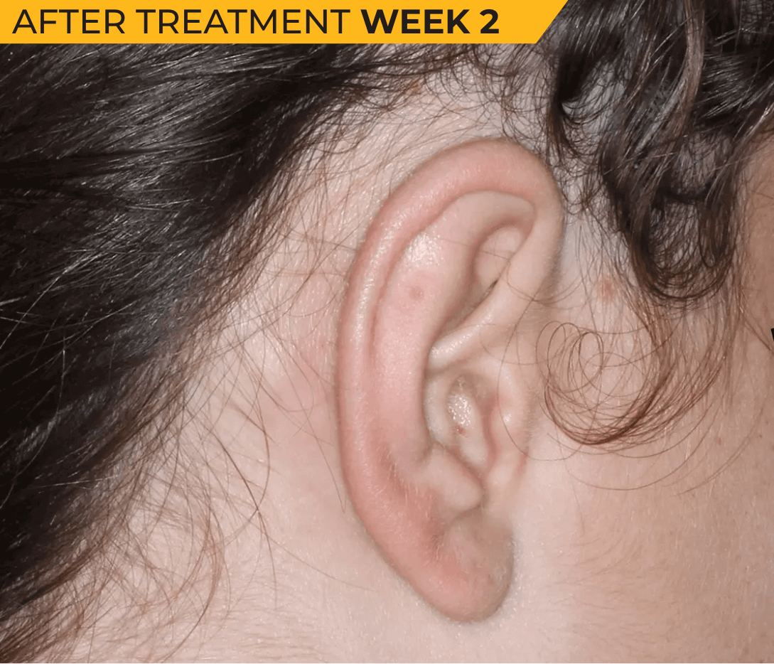 Caucasian American ear with seborrheic dermatitis after treatment Week 2 (actual clinical trial patient photo)