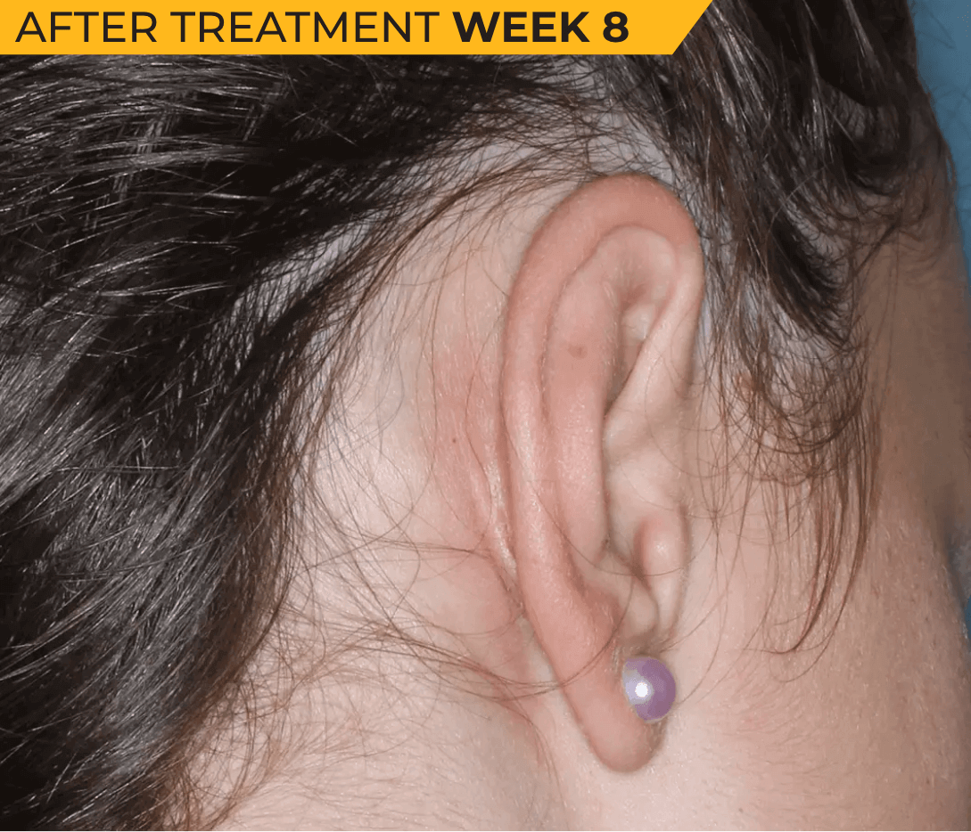 Caucasian American ear with seborrheic dermatitis after treatment Week 8 (actual clinical trial patient photo)