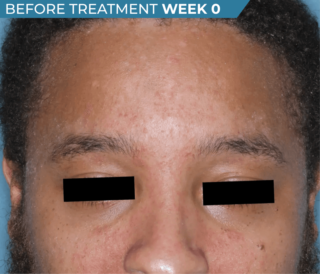 African American man’s face with seborrheic dermatitis before treatment (actual clinical trial patient photo)