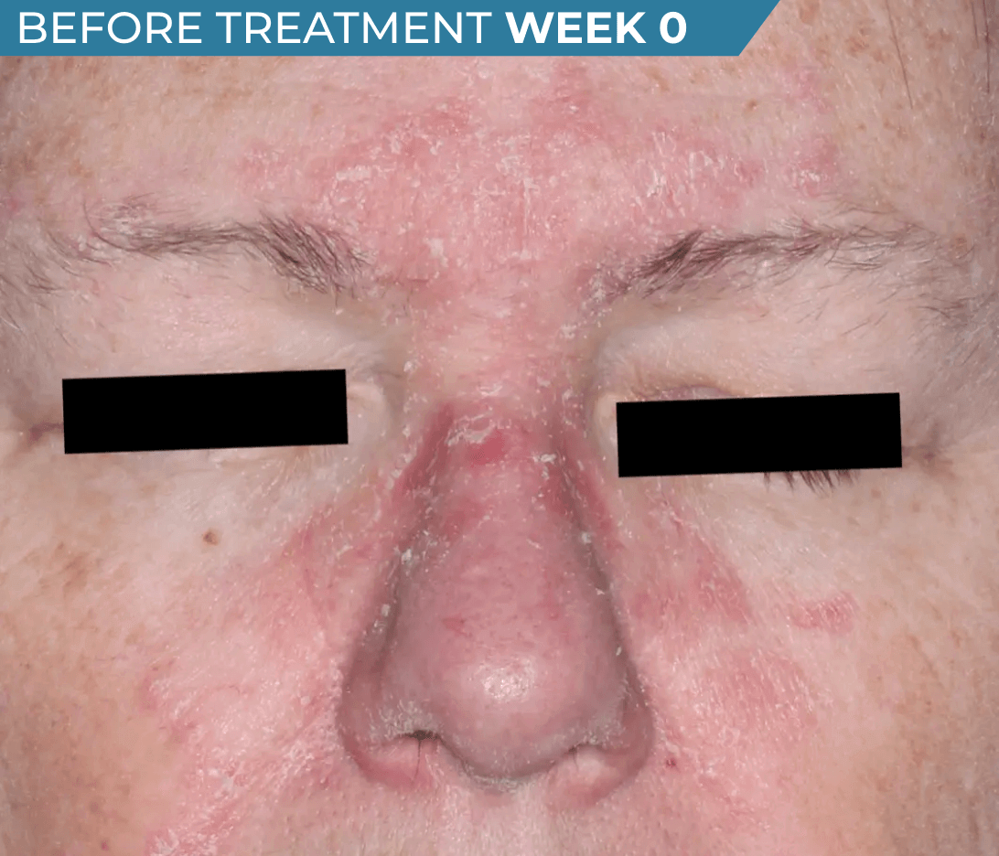 Caucasian American face with seborrheic dermatitis before treatment (actual clinical trial patient photo)