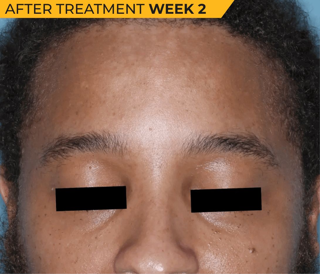 African American man’s face with seborrheic dermatitis after treatment Week 2 (actual clinical trial patient photo)