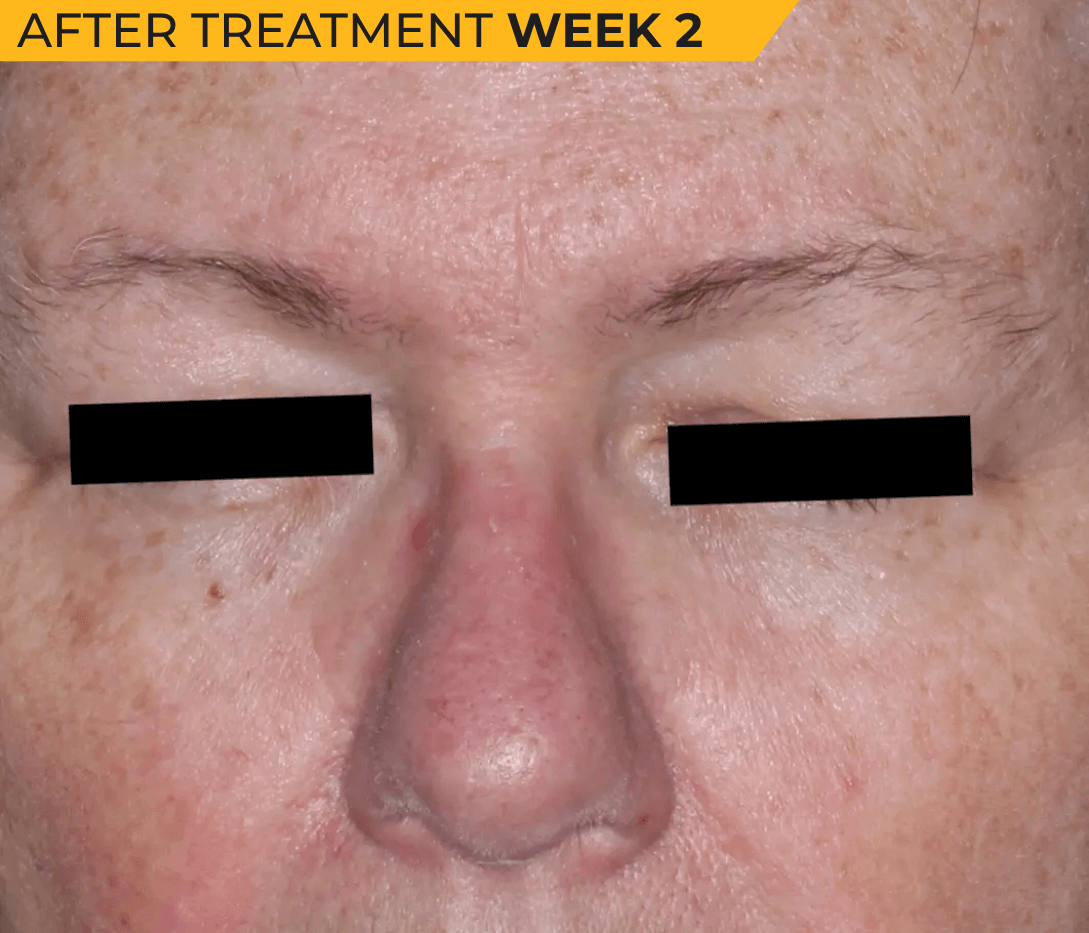 Caucasian American face with seborrheic dermatitis after treatment Week 2 (actual clinical trial patient photo)