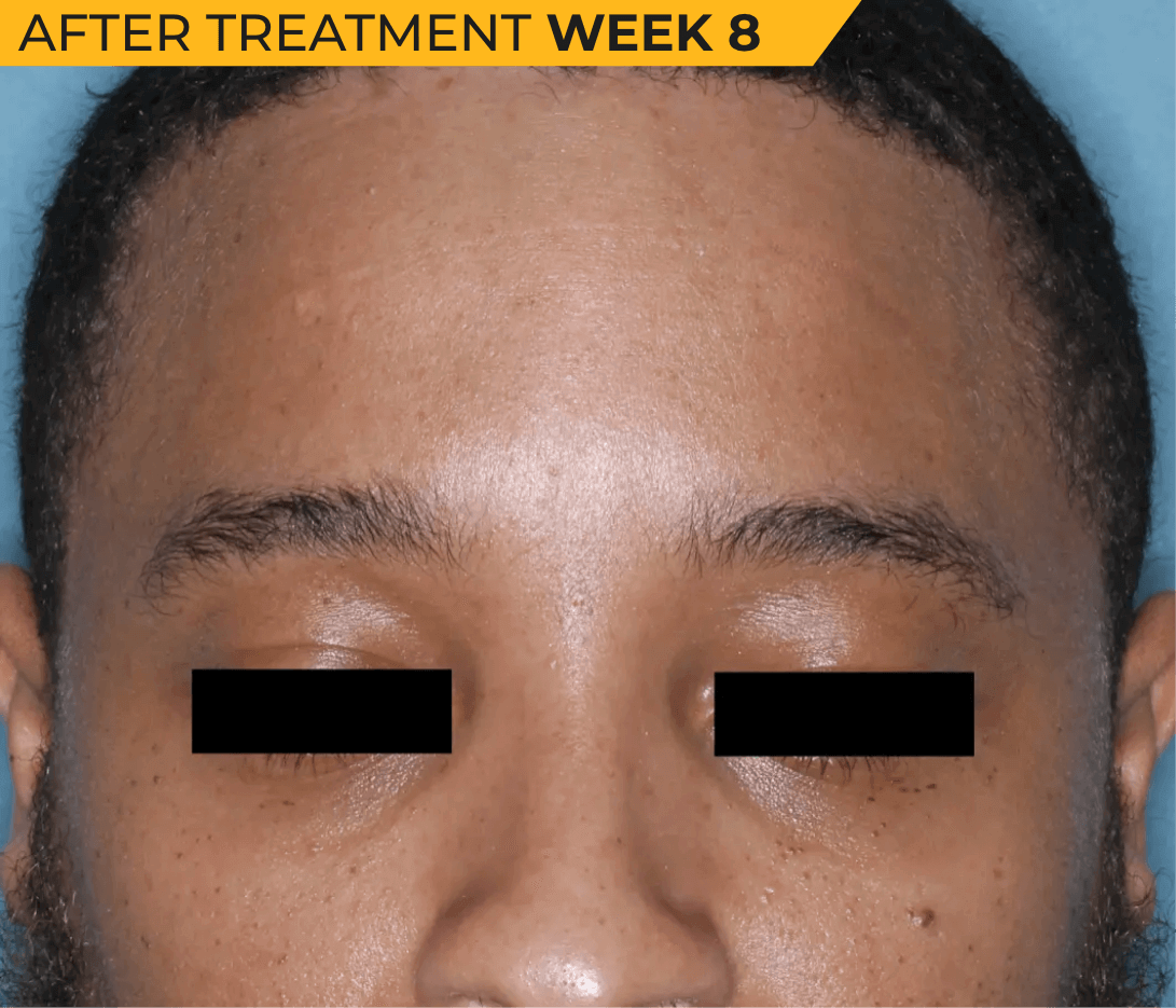 African American man’s face with seborrheic dermatitis after treatment Week 8 (actual clinical trial patient photo)