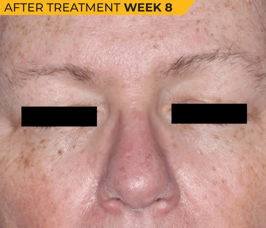 Caucasian American face with seborrheic dermatitis after treatment Week 8 (actual clinical trial patient photo)