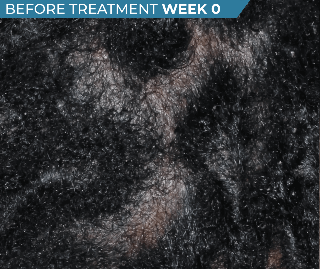 African American scalp with seborrheic dermatitis before treatment (actual clinical trial patient photo)