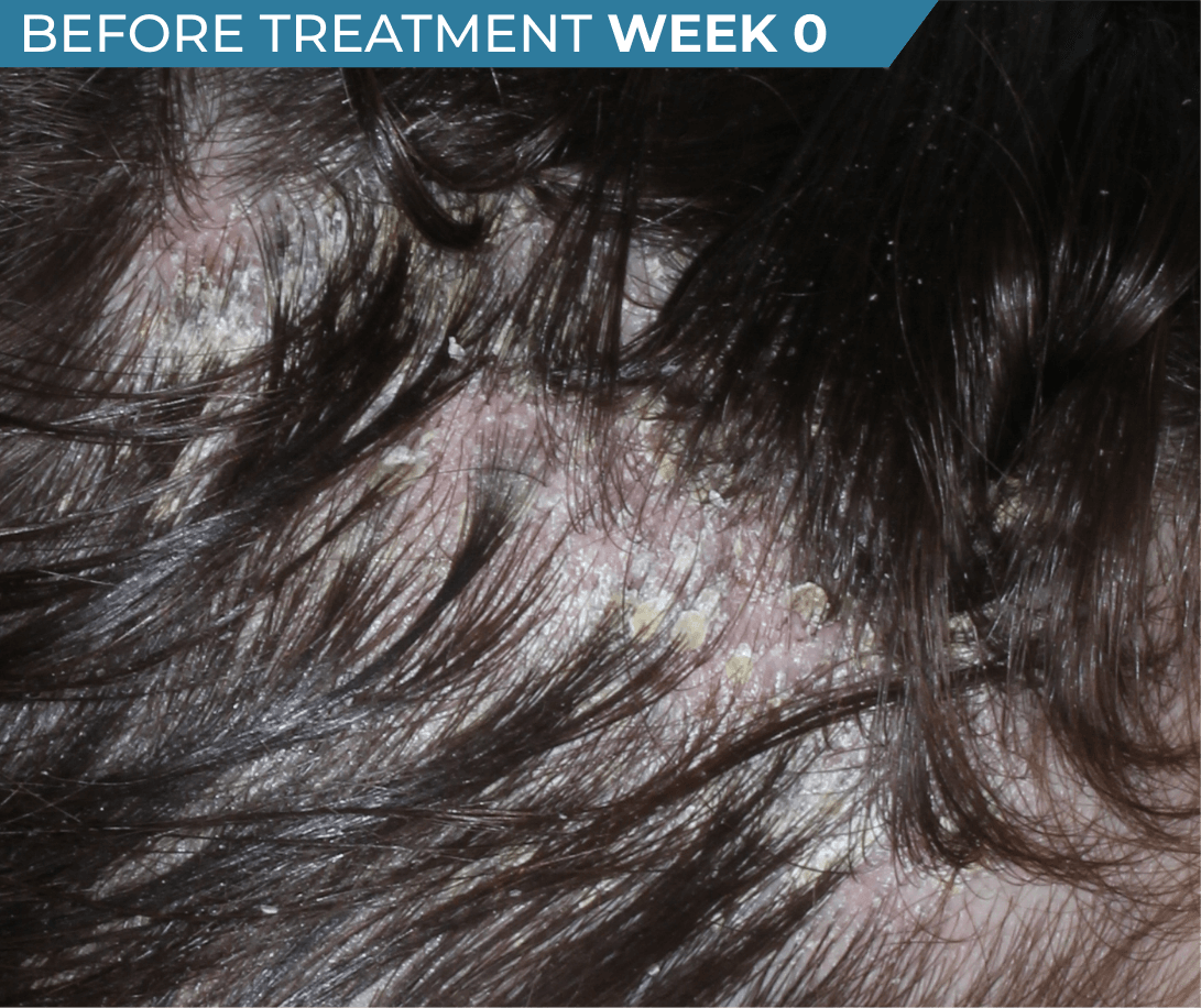 Caucasian American scalp with seborrheic dermatitis before treatment (actual clinical trial patient photo)