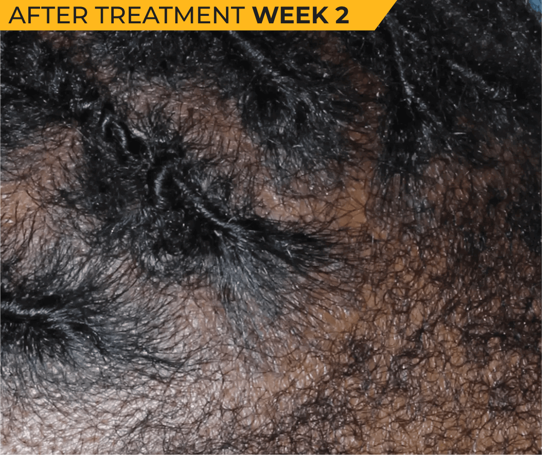 African American scalp with seborrheic dermatitis after treatment Week 2 (actual clinical trial patient photo)