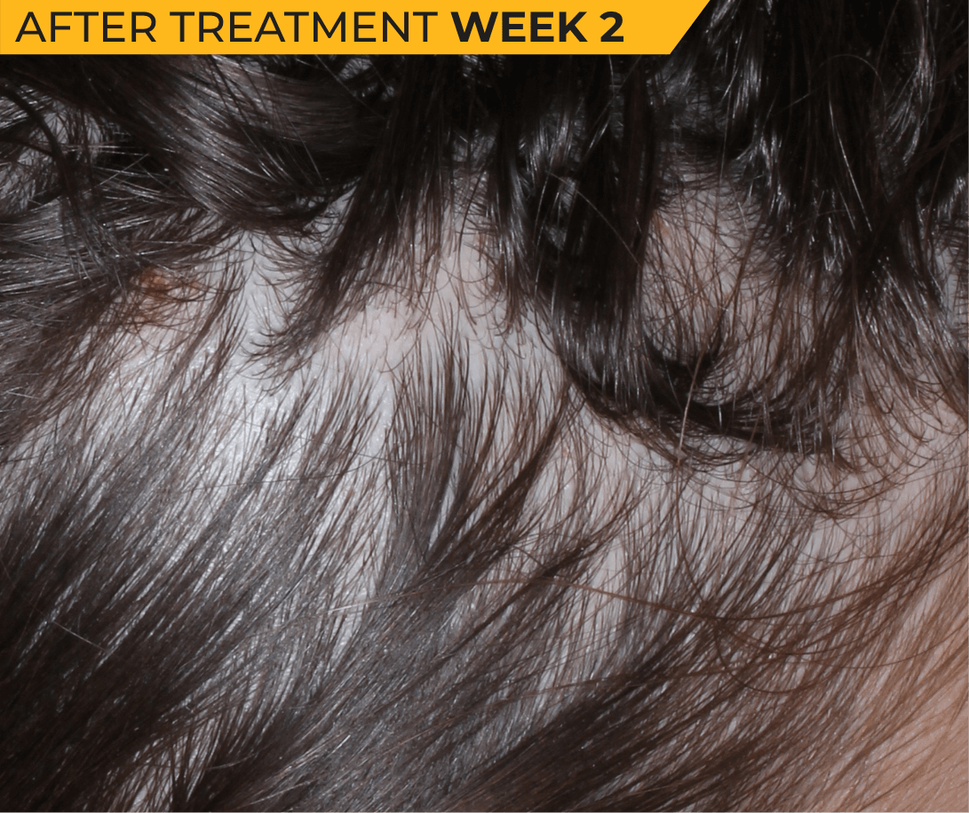 Caucasian American scalp with seborrheic dermatitis after treatment Week 2 (actual clinical trial patient photo)