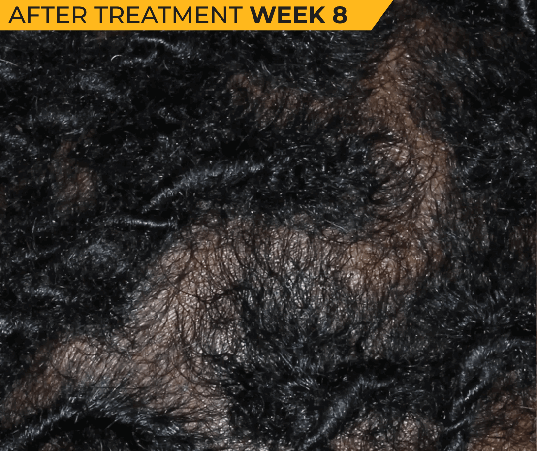 African American scalp with seborrheic dermatitis after treatment Week 8 (actual clinical trial patient photo)