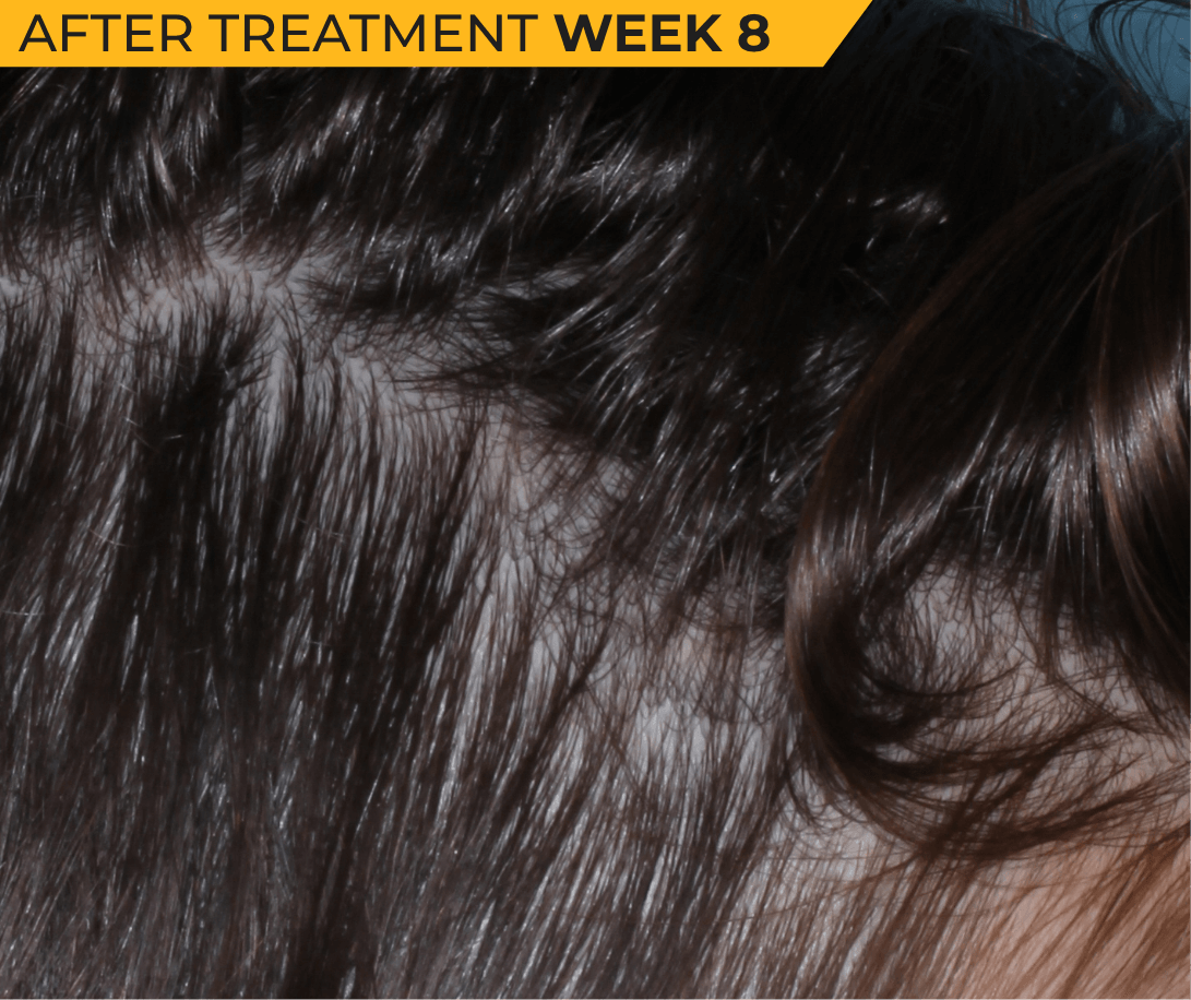 Caucasian American scalp with seborrheic dermatitis after treatment Week 8 (actual clinical trial patient photo)