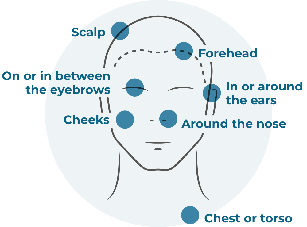 Face and neck illustration showing areas where seborrheic dermatitis can appear, such as scalp, forehead, on or in-between eyebrows, cheeks, around the nose, in or around ears and chest or torso