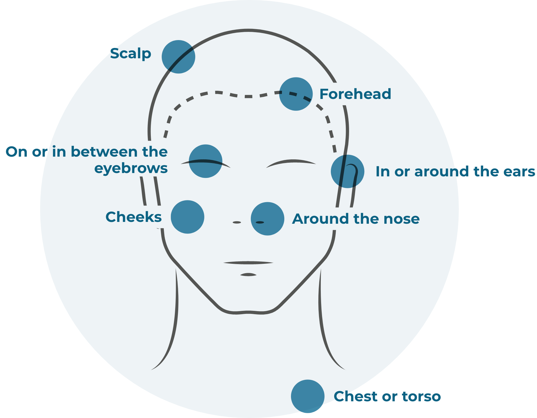 Face and neck illustration showing areas where seborrheic dermatitis can appear, such as scalp, forehead, on or in-between eyebrows, cheeks, around the nose, in or around ears and chest or torso