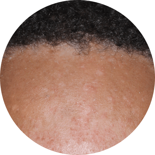 Forehead showing discoloration 